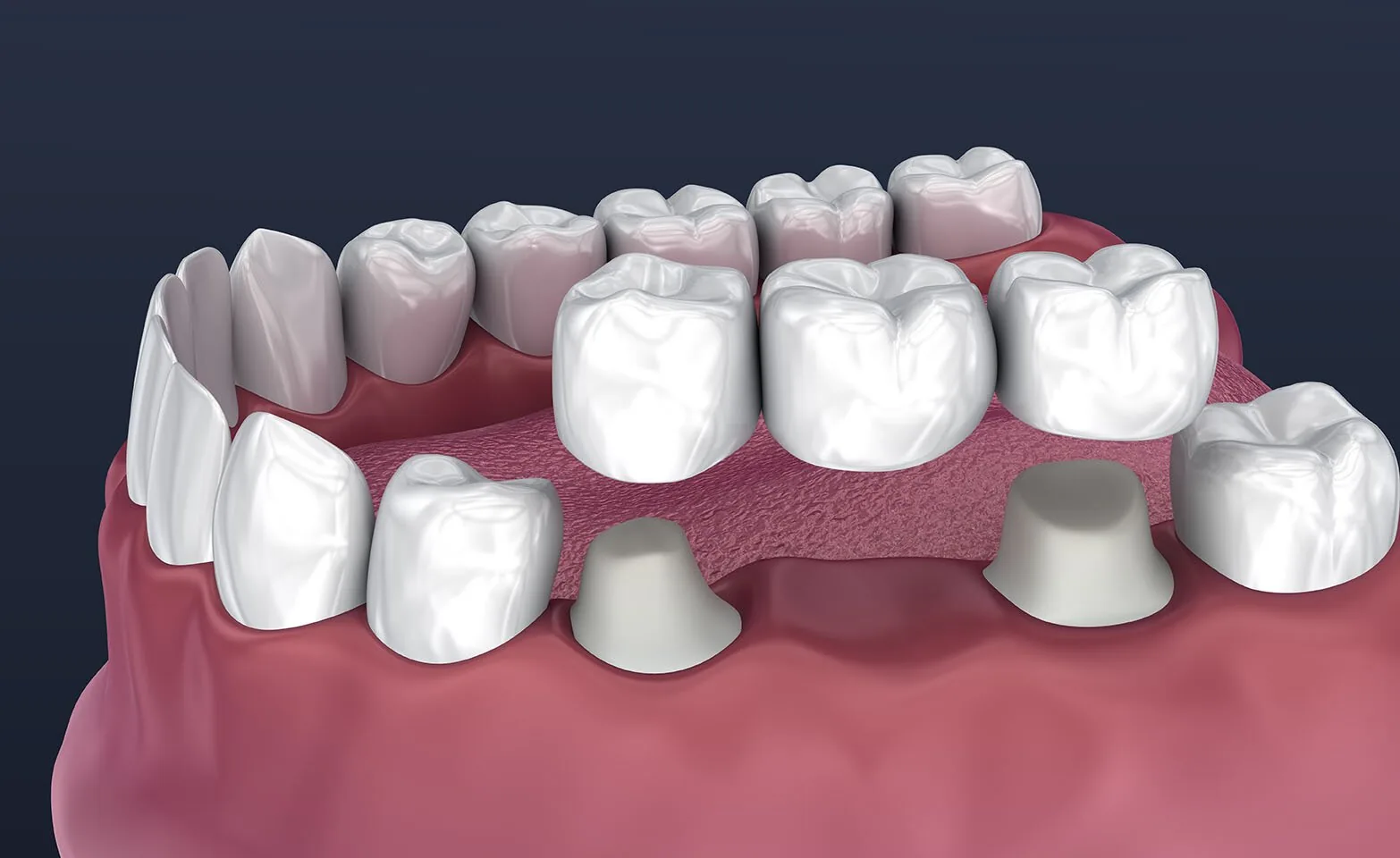 Мостовидные протезы